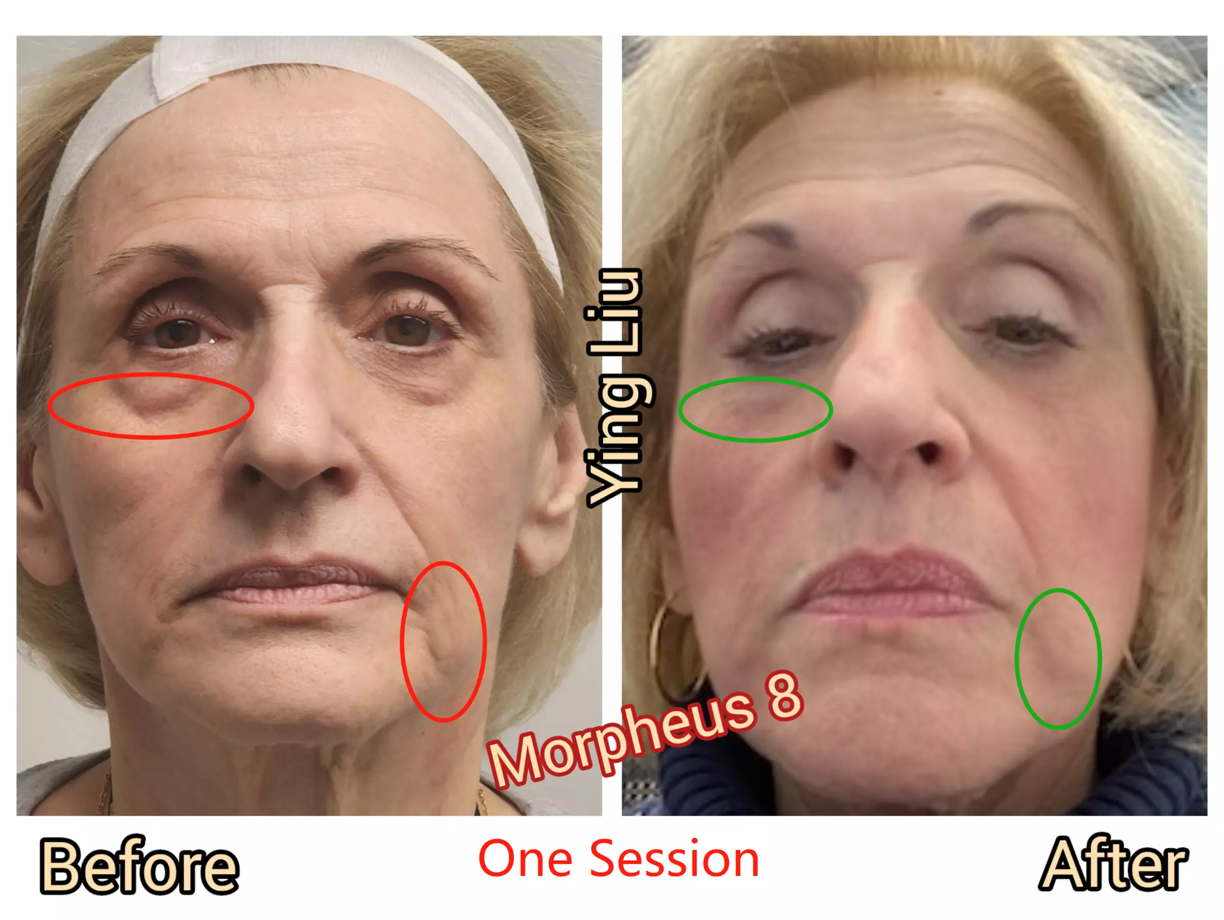 Up to 90% Off on Radio Frequency Skin Tightening at Anchor Family Medicine and Medical Spa - Second Medium