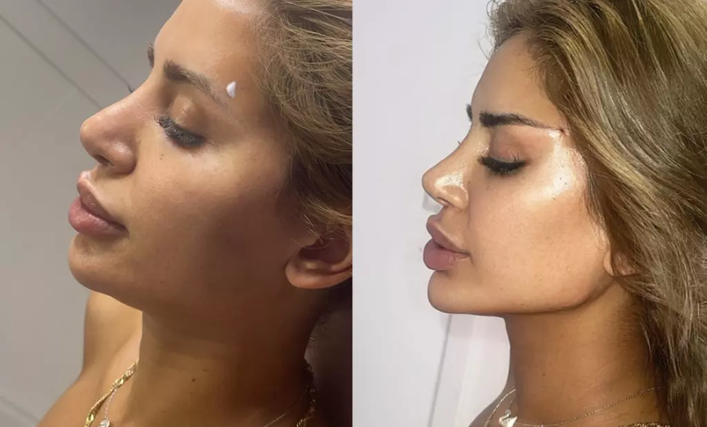 Up to 33% Off on Injection - Organic Filler at Faces by AKJ New York City - Primary Image