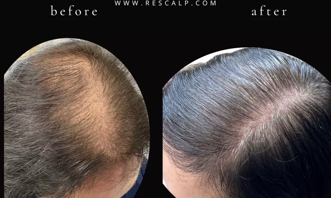 Up to 90% Off on Hair Restoration - Non-Surgical at ReScalp SMP | Scalp Micropigmentation - Primary Image