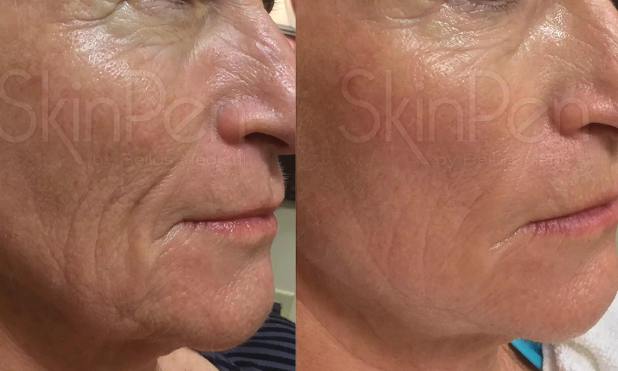 Up to 46% Off on Micro-Needling at Palm Beach Body Sculpting - Second Medium