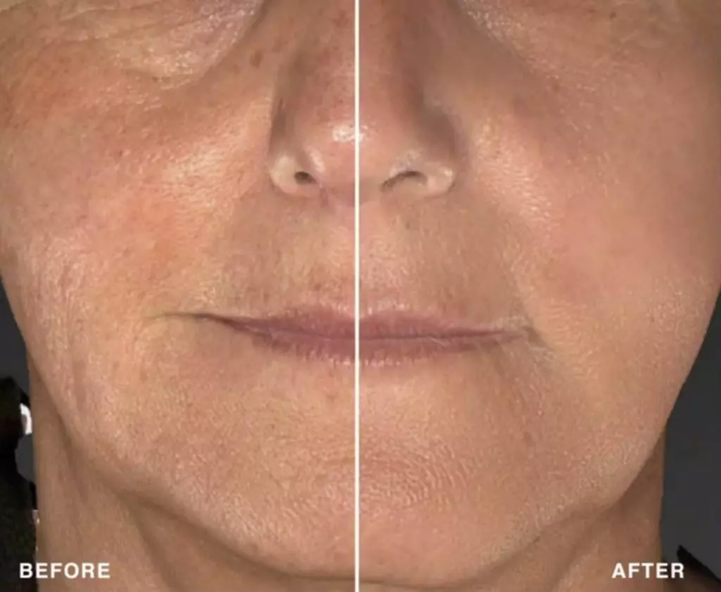 Up to 58% Off on IPL Photo Facial at Core Rejuvenation Wellness And Medspa - Primary Image