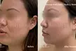 Experience skin lifting and tightening at One Beauty Aesthetics with Ultherapy treatments for chest or neck, up to 60% off - Second Medium