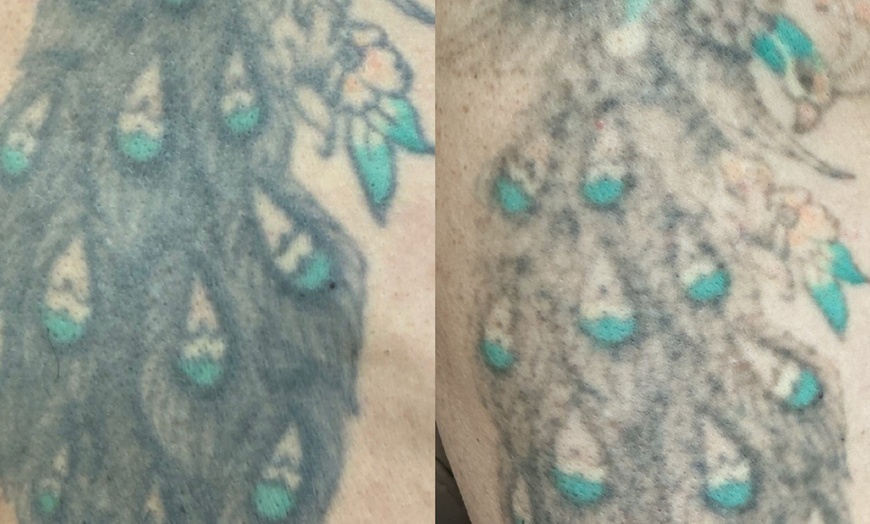 Image 5: Up to 73% Off on Tattoo Removal at LA Tox Medspa