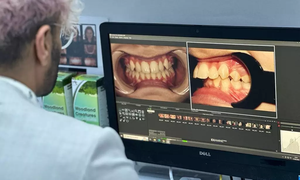 Clear or Metal Braces on One or Both Arches