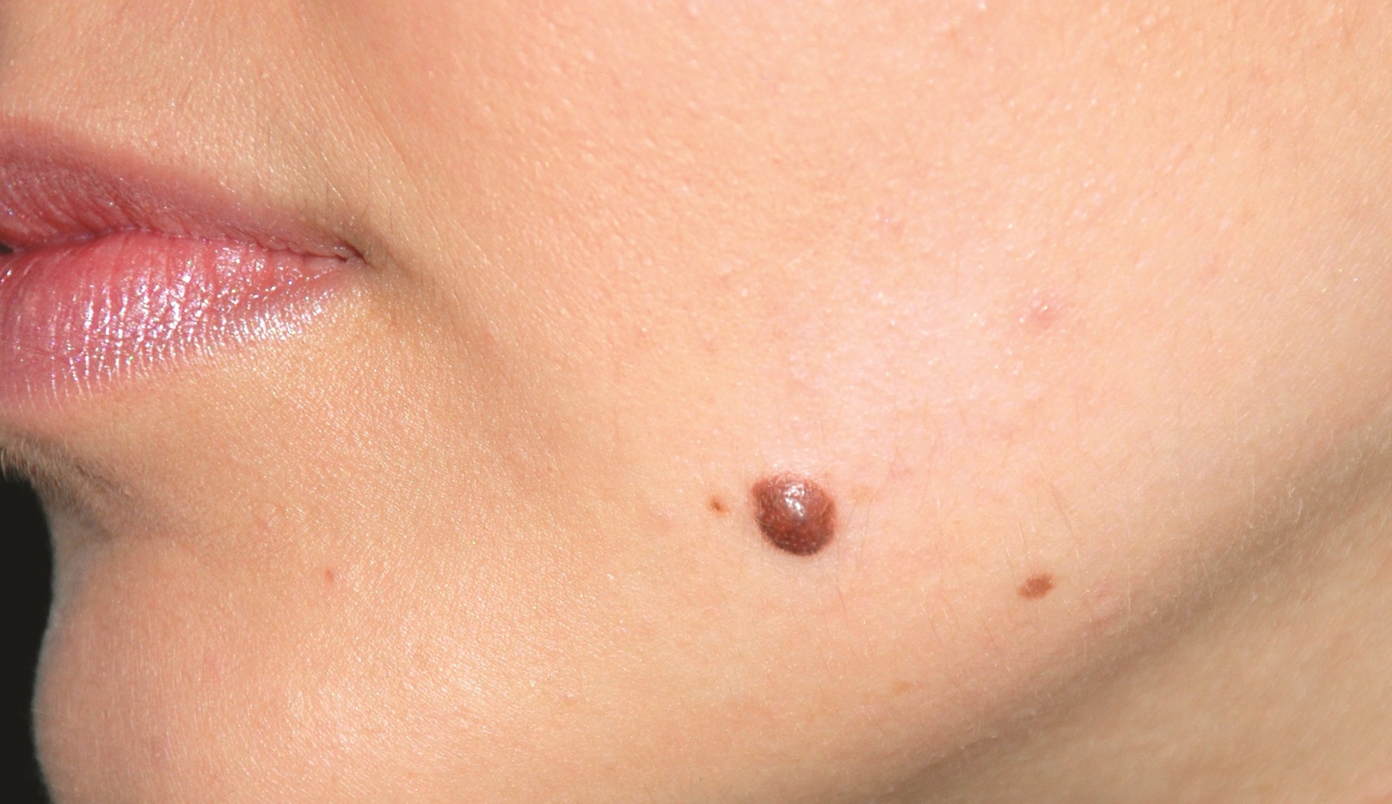 Copper Valley Medical LLC offers skin lesion removal for face and body with up to 75% off various options