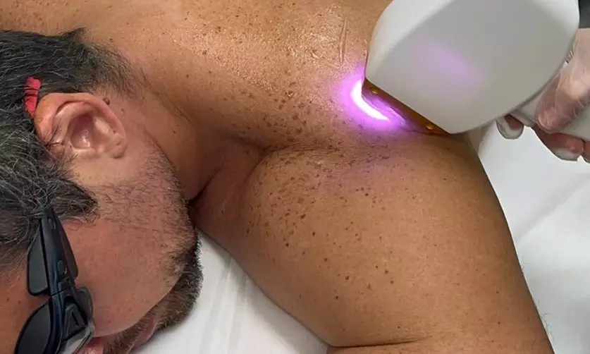Six Laser Hair-Removal Sessions on Various Areas