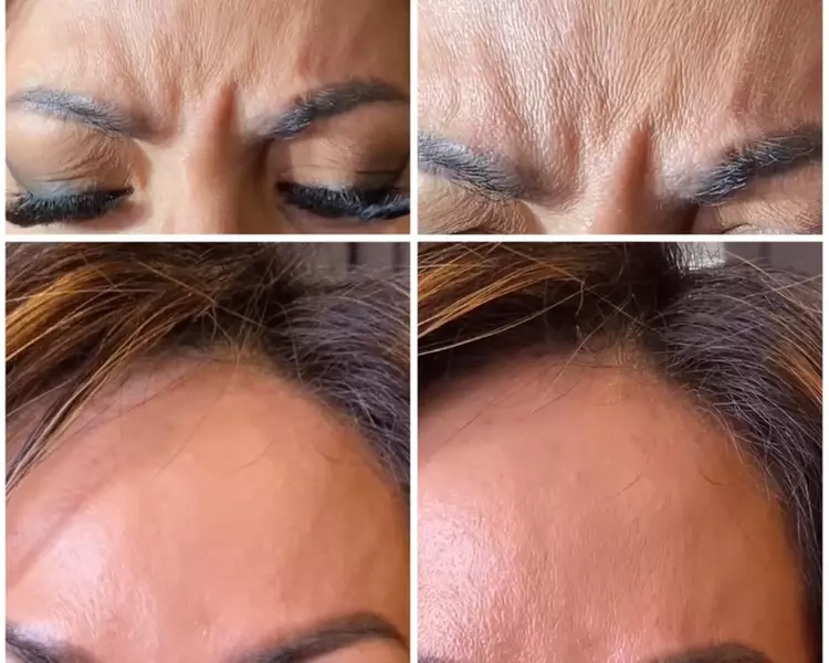 Up to 19% Off on Injection - Botox at Ameze Skin Elements