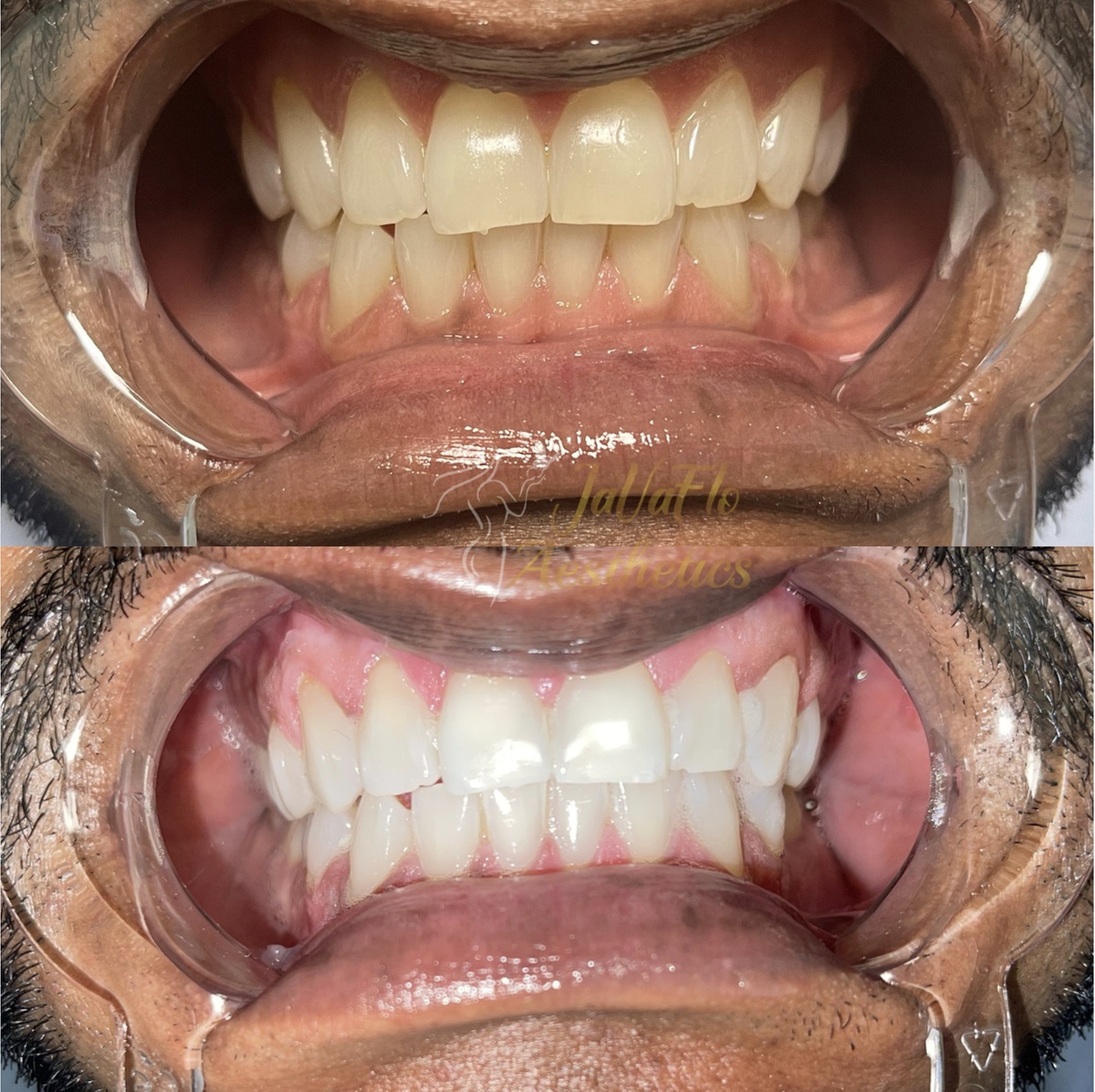 Up to 55% Off on Teeth Whitening at Javafloaesthetics