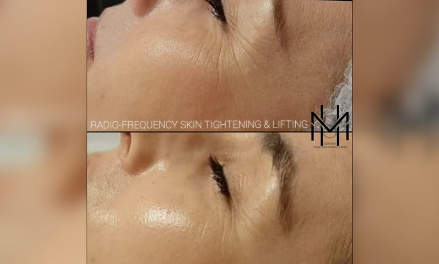 Image 1: Radio Frequency Skin Tightening at London PMU MastersHands