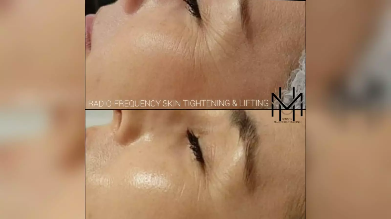 Fractional Radio Frequency OR Cryo Radio Frequency - Non Surgical Face Lifting & Tightening - Primary Image