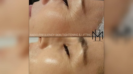 Cryo Radio-Frequency Skin Tightening & Lifting With Peptides Cleanse- Face