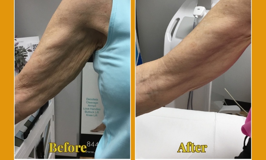 Image 9: Ultherapy Prime Treatment with for Face, Neck and Chest 