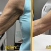 Image 9: Ultherapy Prime Treatment with for Face, Neck and Chest 