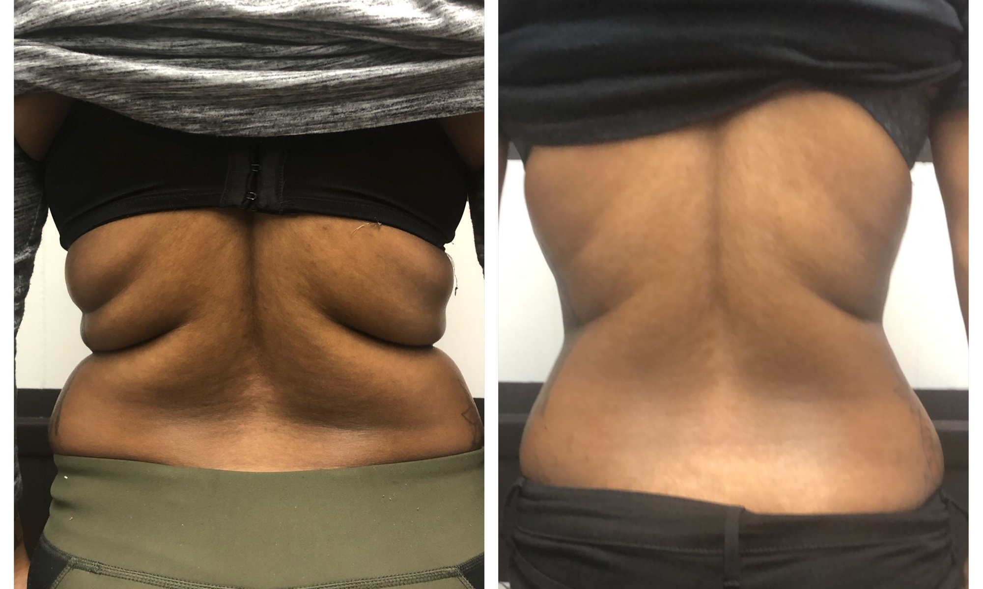 Up to 50% Off on Non invasive Brazilian Butt Lift Treatment at Arched by Amaris