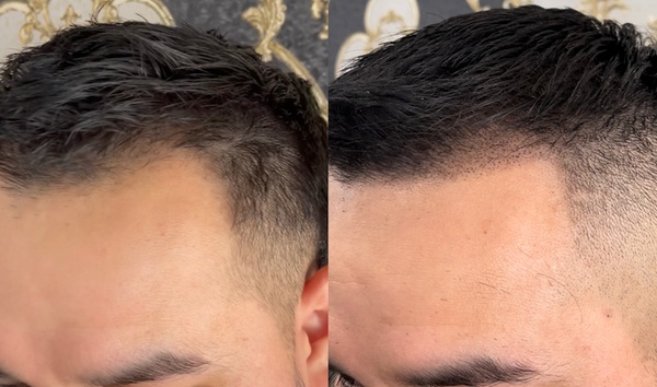 Widow's Peak Vs Receding Hairline | isgb.edu.ar