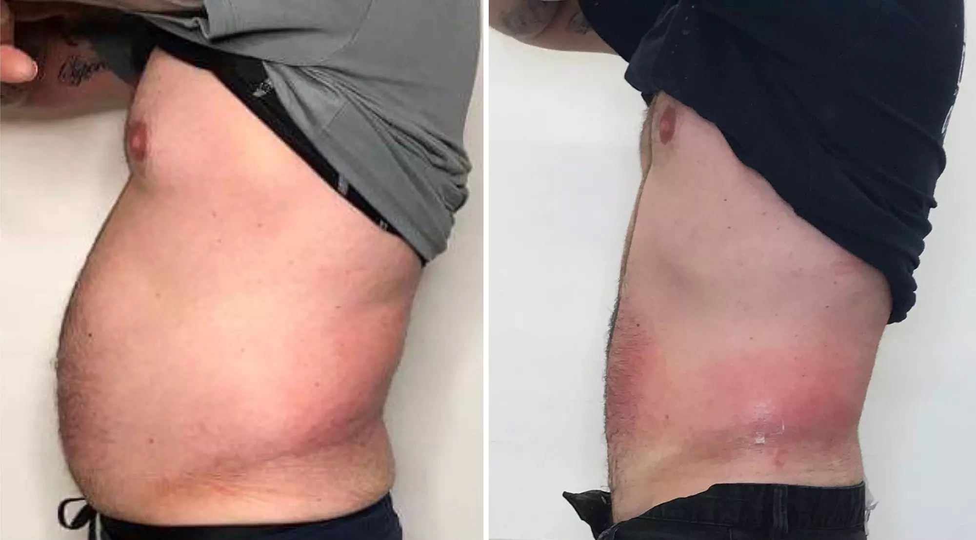 Transform with Man Spa Club's body sculpt sessions: choose laser-lipo or cavi-lipo options up to 60% off - Second Medium