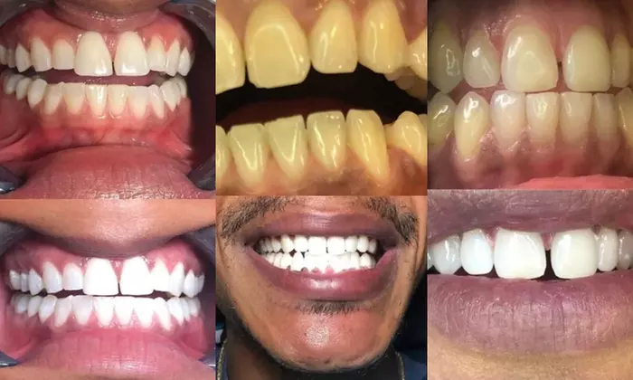 Up to 60% Off on Teeth Whitening at Perfectly imperfect smiles - Primary Image