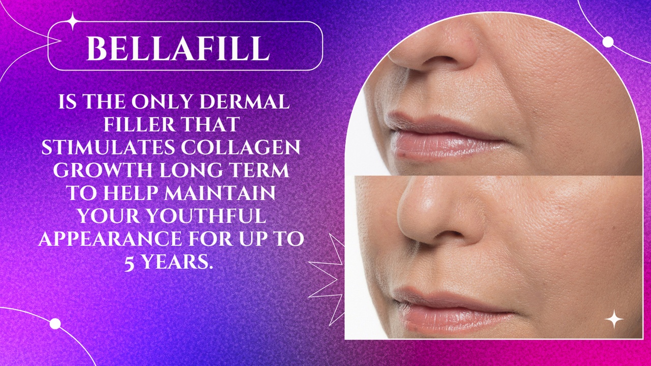 Bellafill: Long-Lasting Fillers for a Youthful Glow