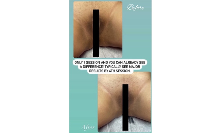 Image 1: Waxing Services: Brazilian, Bikini, and Intimate Bleaching Available