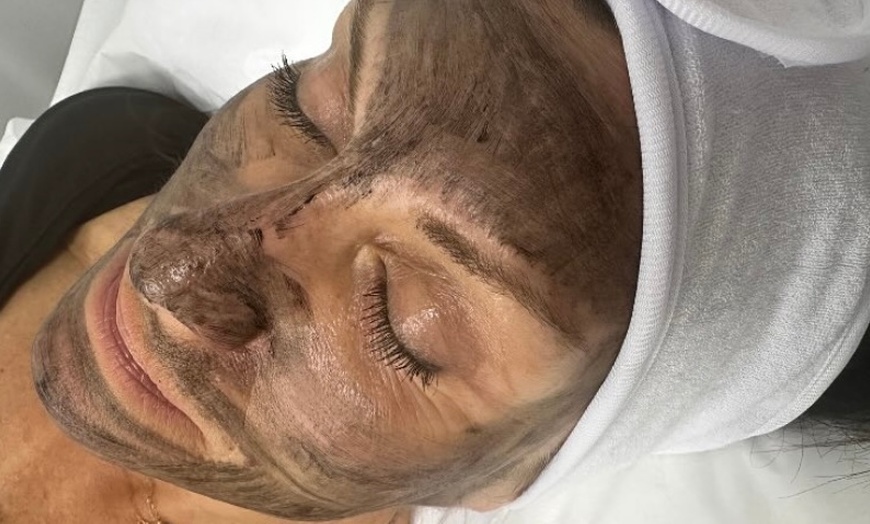 Image 2: Pico Laser Carbon Peel with Complimentary Facial Cleaning
