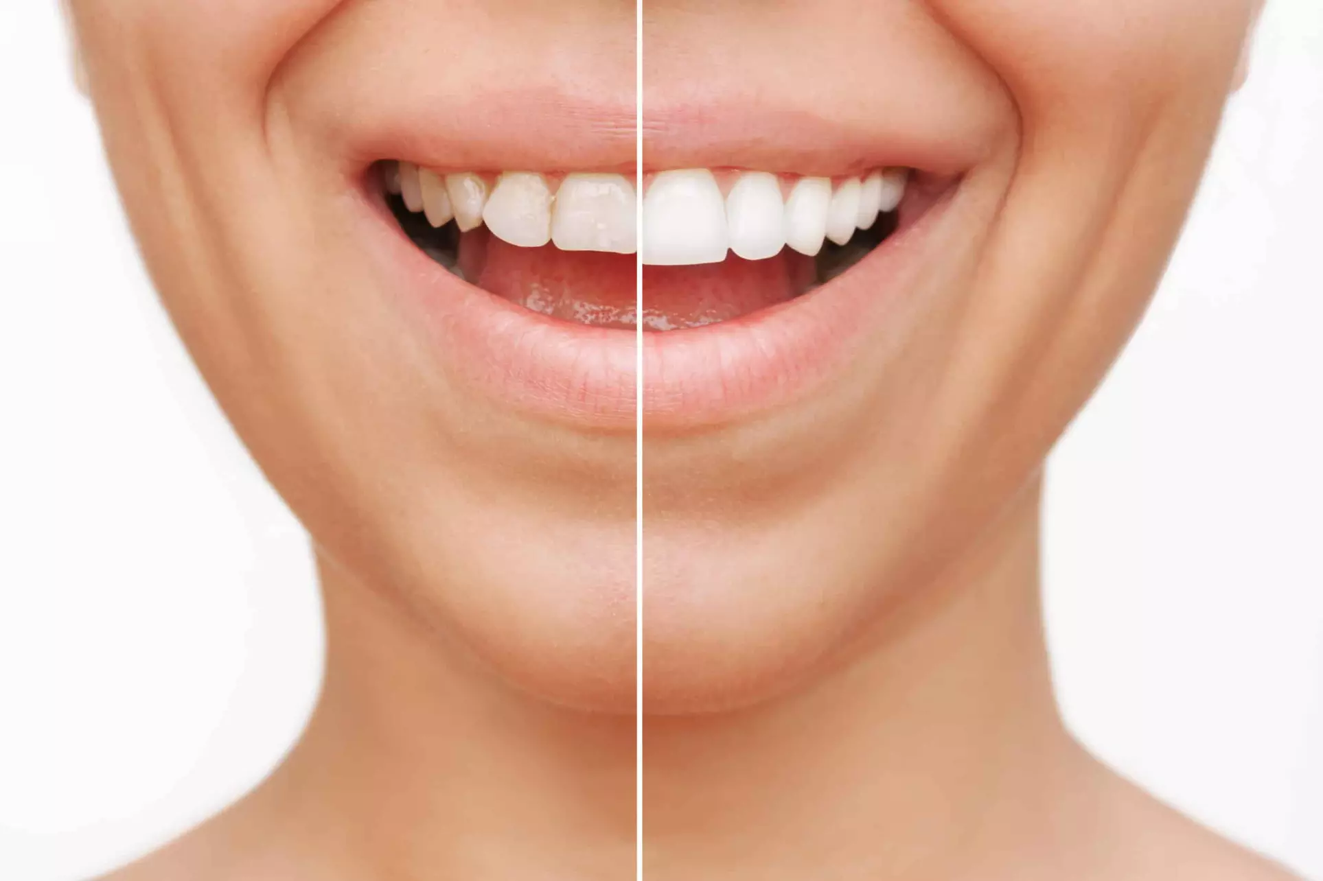Up to 75% Off on Teeth Cleaning at Diamond Dental of Beachwood; Barry Diamond D.D.S.