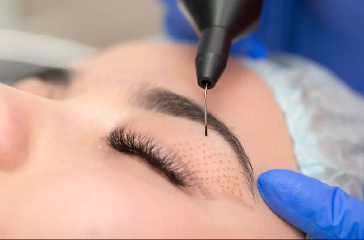 Up to 52% Off on Laser Skin Resurfacing-Unbranded at Esthetic Beauty - Second Medium