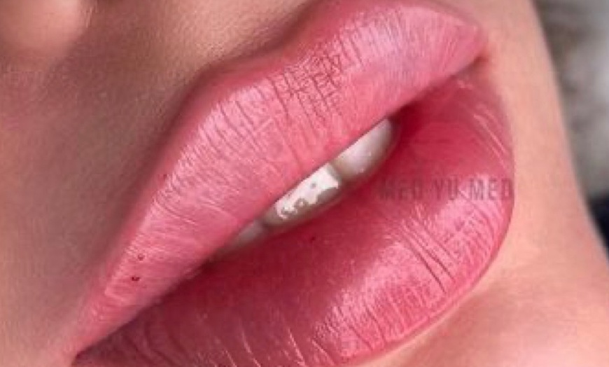 Image 4: Lip Filler Treatment at Transphom Aesthetic