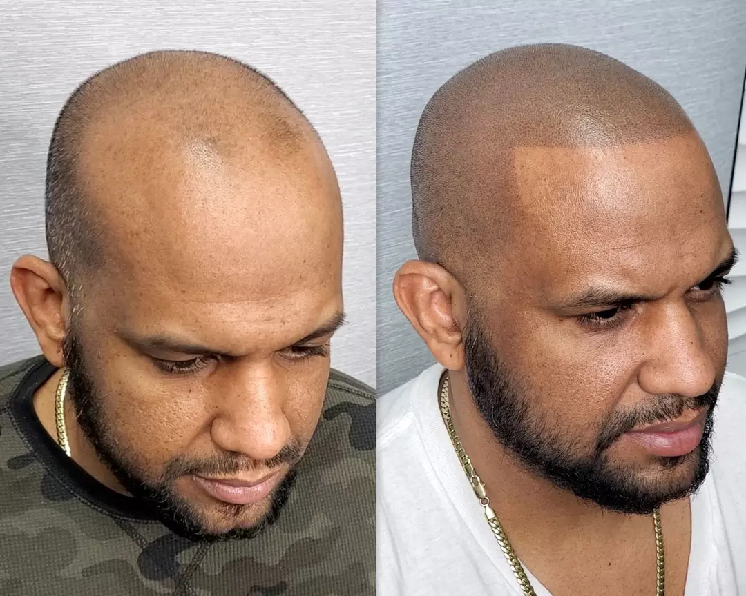 Up to 20% Off on Hair Restoration - Non-Surgical at Top Micro Ink - Second Medium