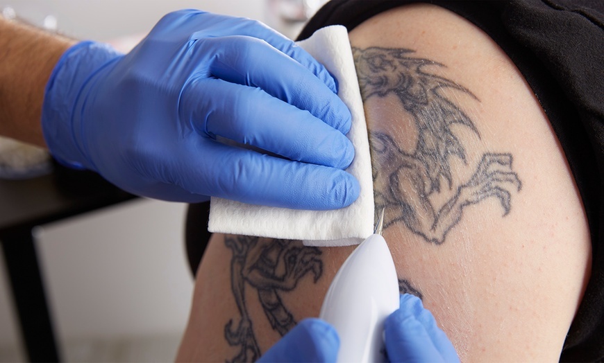 Image 1: Up to 63% Off on Tattoo Removal at Reading Beauty Salon