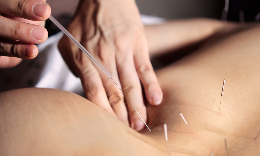 Image 5: 90-Minute Initial Acupuncture or Acupuncture & Cupping Session