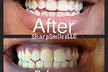 Get A Dazzling Smile With 30 Or 60-Min Teeth Whitening, Gentle Polish or Customizable Tooth Gems At 69% Off - Second Medium
