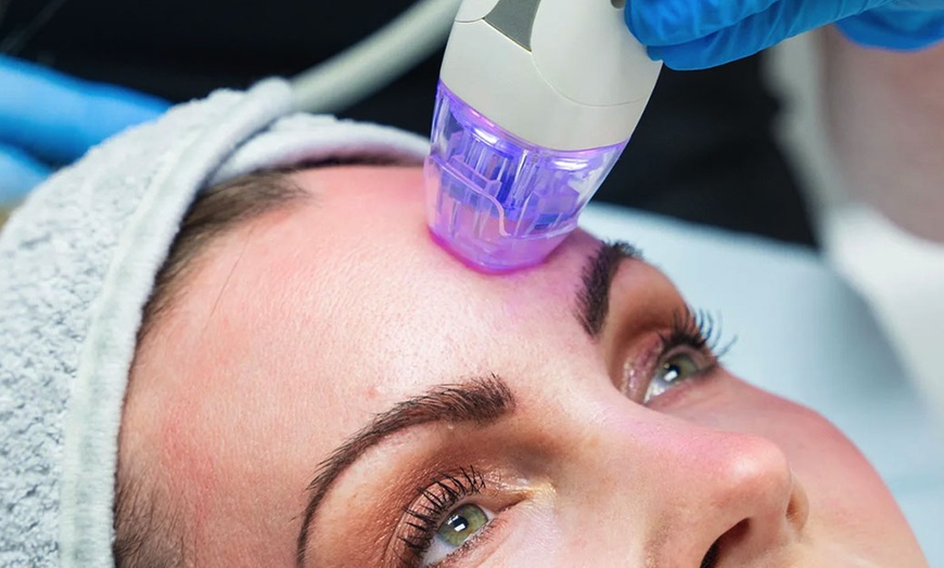 Image 1: Up to 40% Off on Micro-Needling at UK Aesthetics Lounge