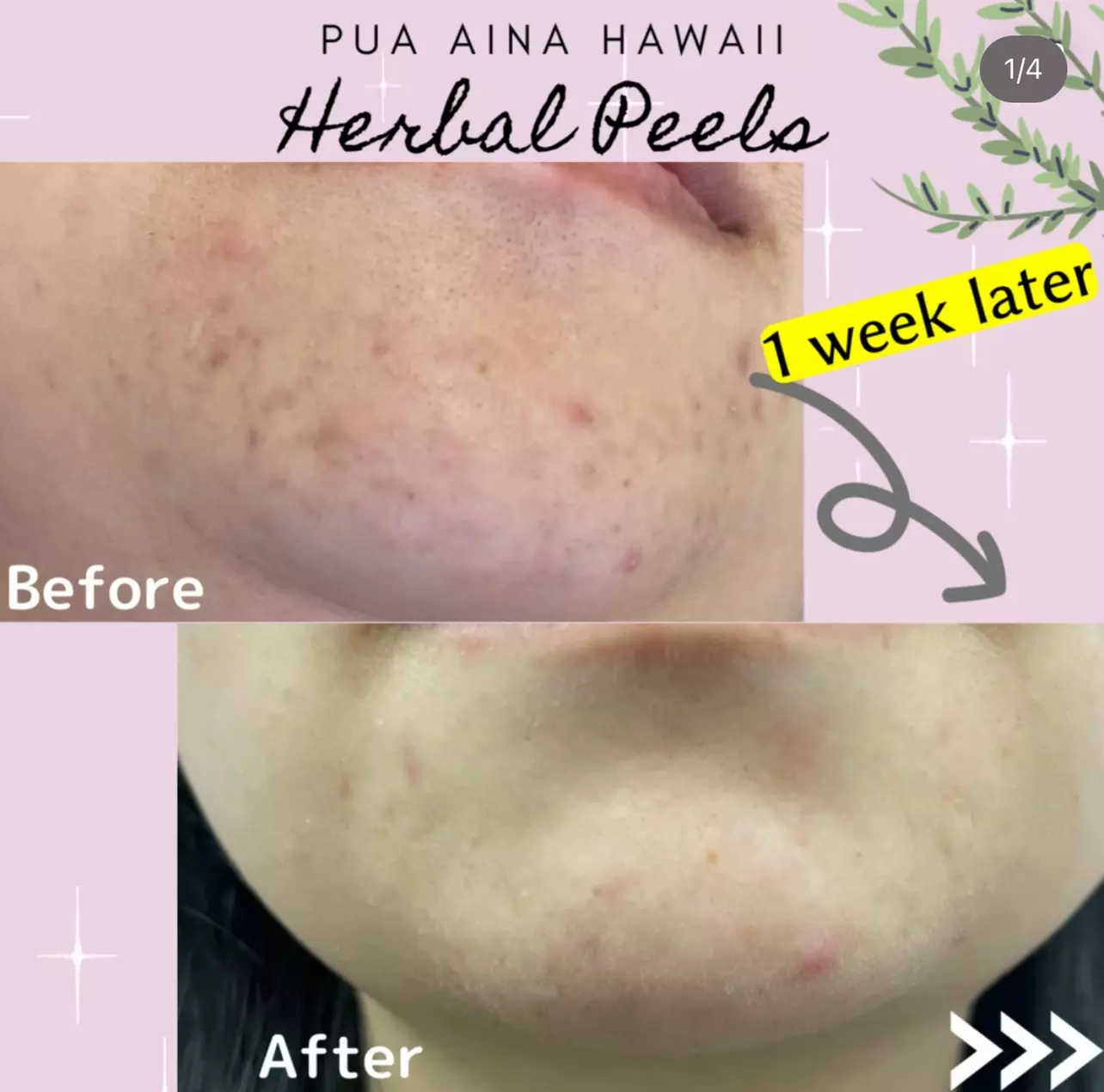 Up to 25% Off on Facial - Peeling at Pua Aina Hawaii - Second Medium