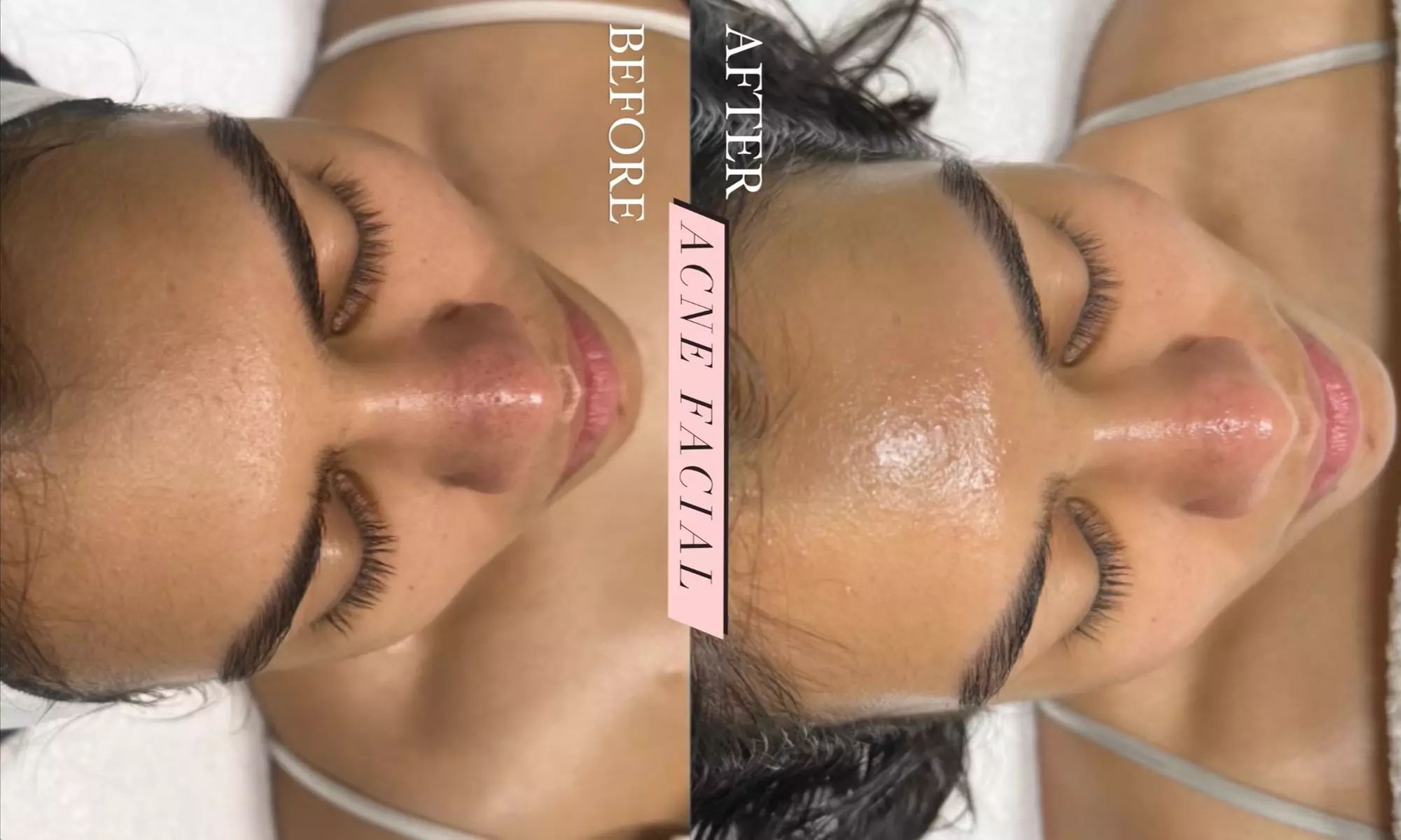 60-Minute Acne or Anti-Aging Facial with LED Therapy