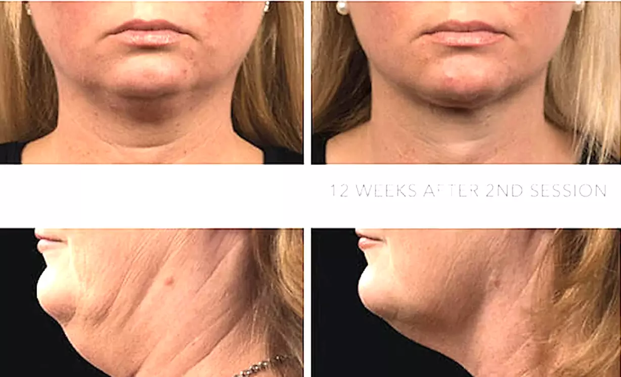 Up to 55% Off on Facial - Anti-Ageing at United Kingdom