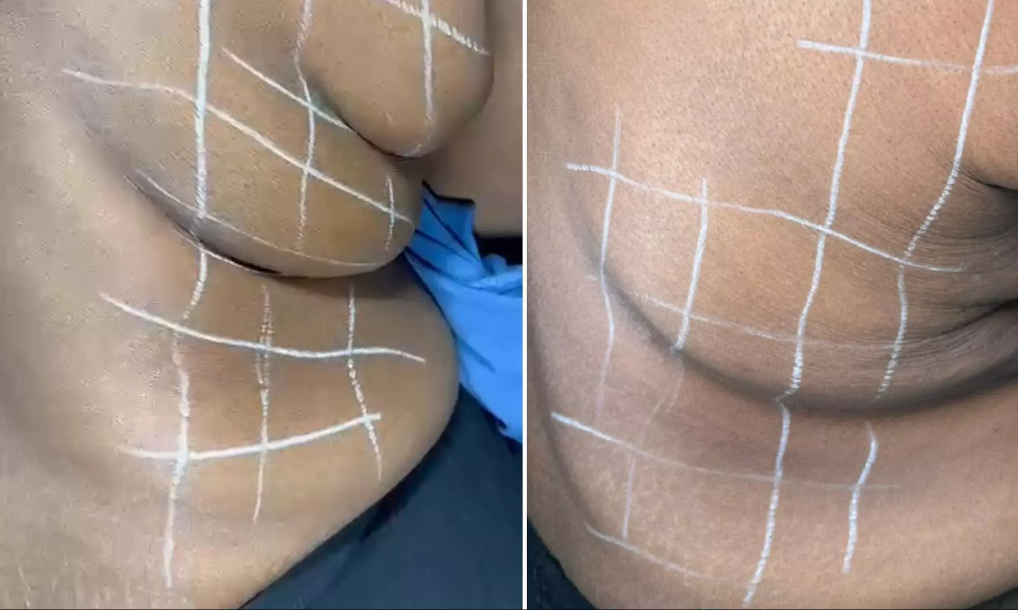 Up to 50% Off on Fat / Cellulite Reduction - Non-Branded at Noire Aesthetics