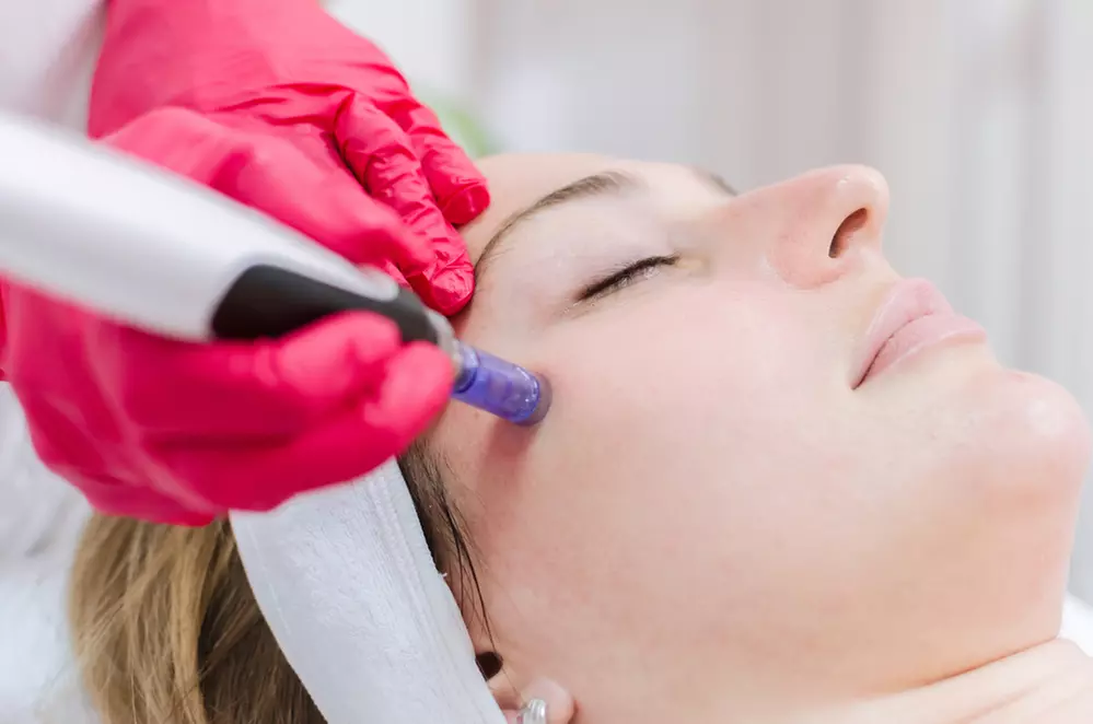 Up to 65% Off on Micro-Needling at Nadia