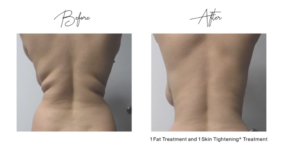 Up to 75% Off on Fat Reduction - Non-Branded at SureMED Aesthetics
