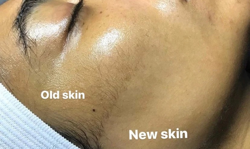 Revitalize Your Skin with Dermaplaning and LED Treatment