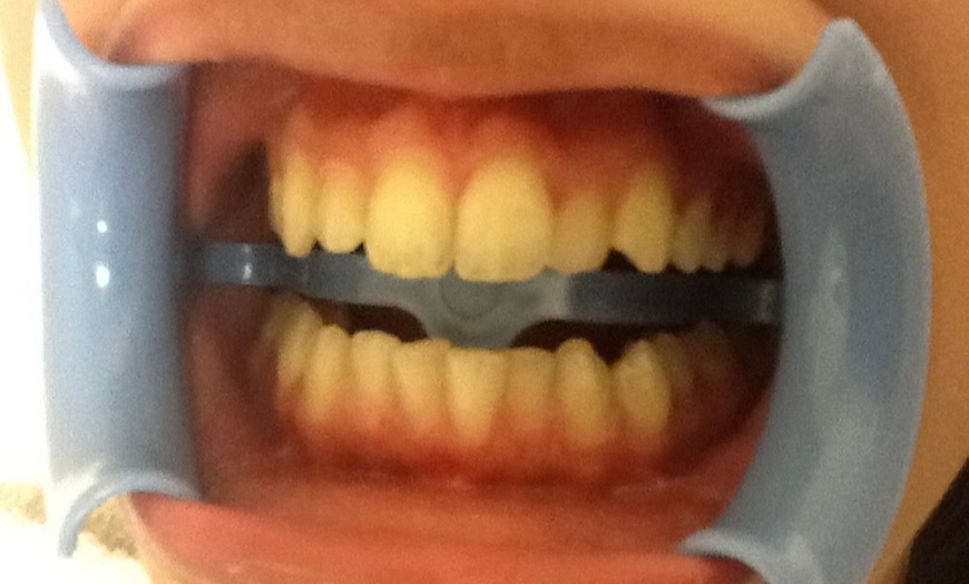 Image 2: In-Chair LED Teeth Whitening