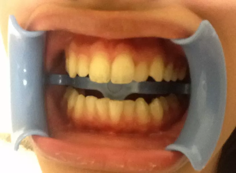 In-Chair LED Teeth Whitening