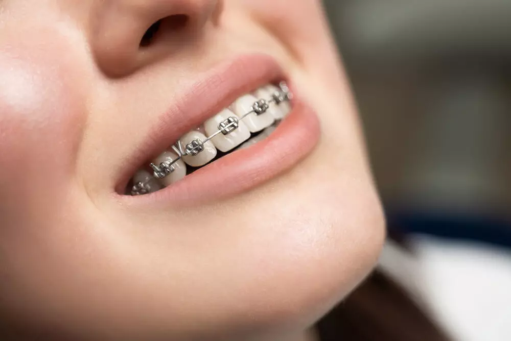Braces - Metal at The smile mission (Up to 99% Off) - Primary Image