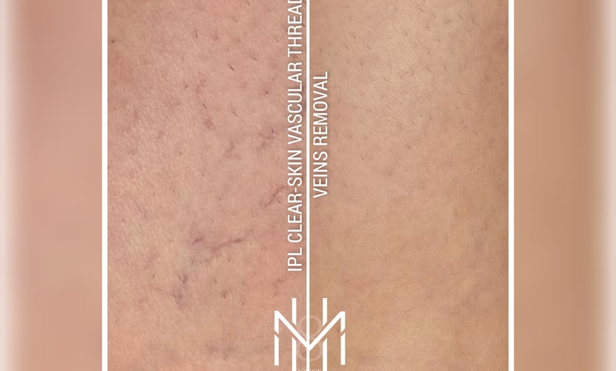 Image 2: Up to 69% Off on Spider Vein Removal - IPL at London PMU MastersHands