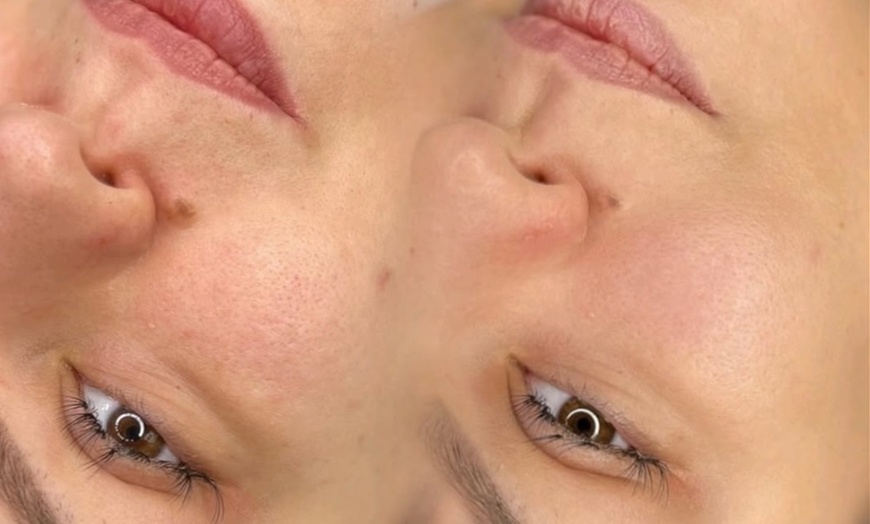 Image 2: Microneedling oder BB Glow inkl. Abreinigung für 1 Person