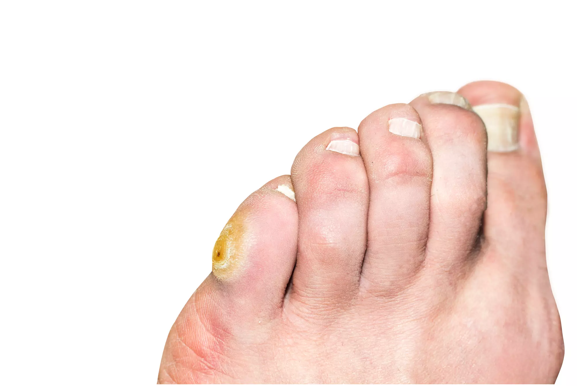 Get Back on your Feet with One or Two Corn Removal at Raymond Nash (Up to 87%) - Primary Image