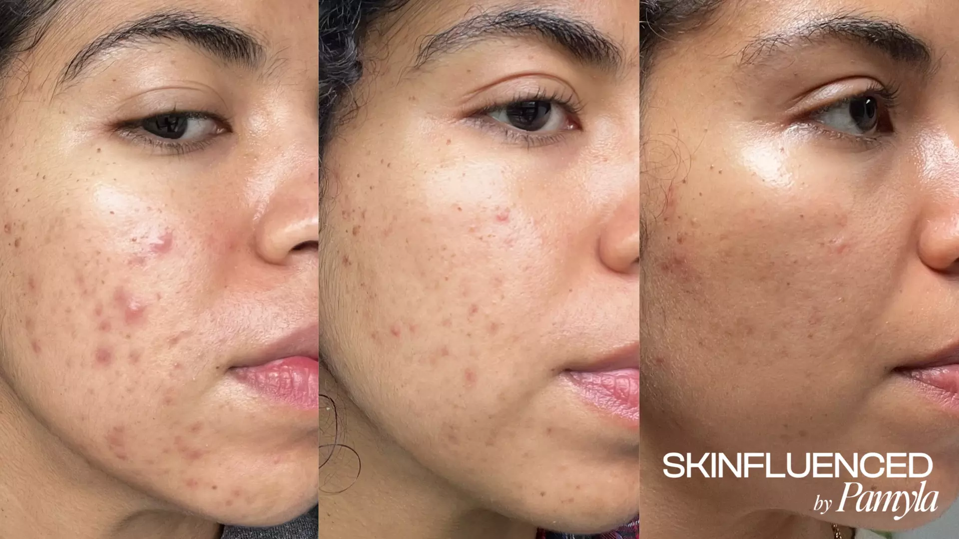 Up to 40% Off on Acne Treatment at SKINFLUENCED by Pamyla - Primary Image