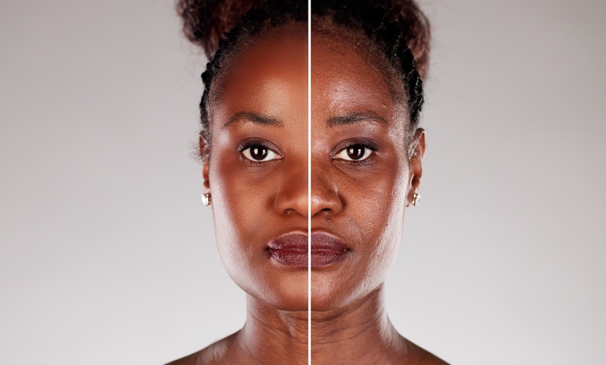 Image 6: Laser Skin Resurfacing Treatment at Rewind Medical Spa by Sharicom Health(Up to 30% Off)