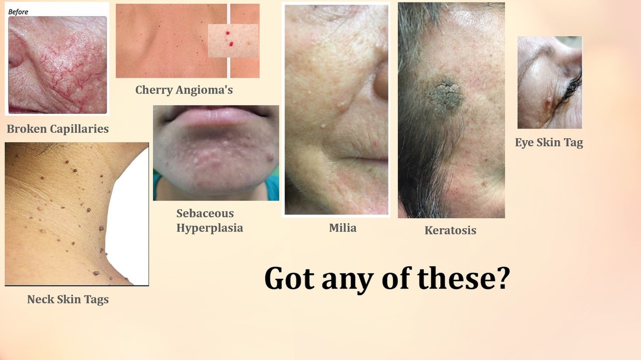 Effective Skin Tag and Brown Spot Removal Options Available
