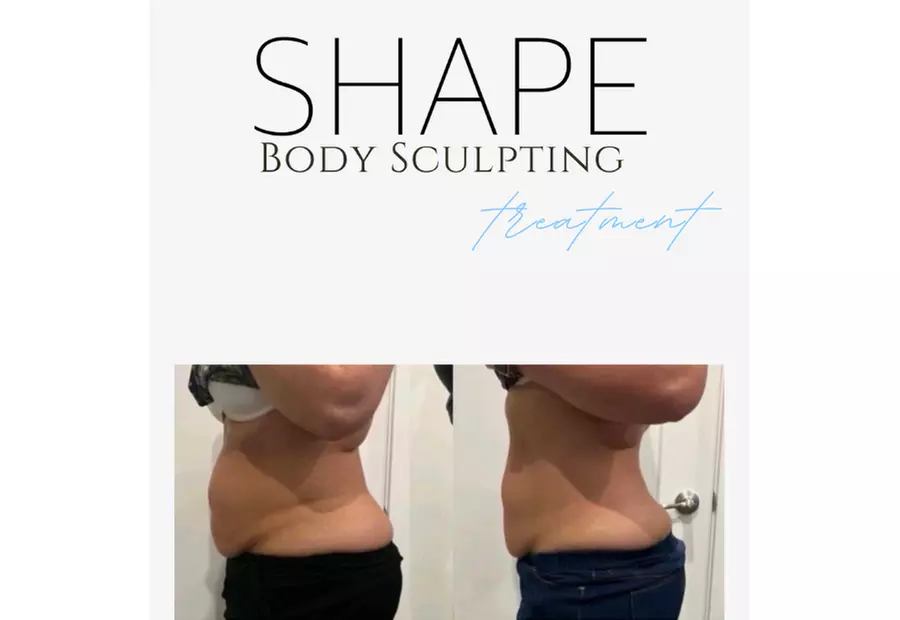 Fat Freezing Cryo Body Sculpting Packages with Big Savings