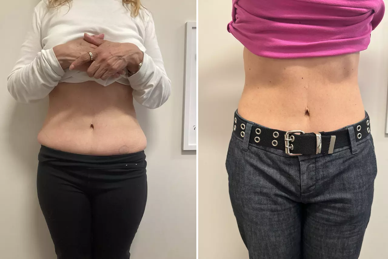 Get Toned Body with NuEra Tight with FocalRF Technology Skin Tightening at Aesthetic Mind MD (Up to 56% Off)